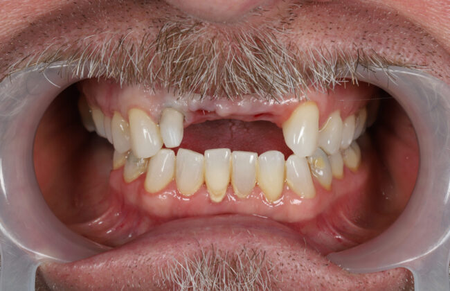 Before (Teeth)