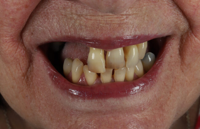 Before (Teeth)