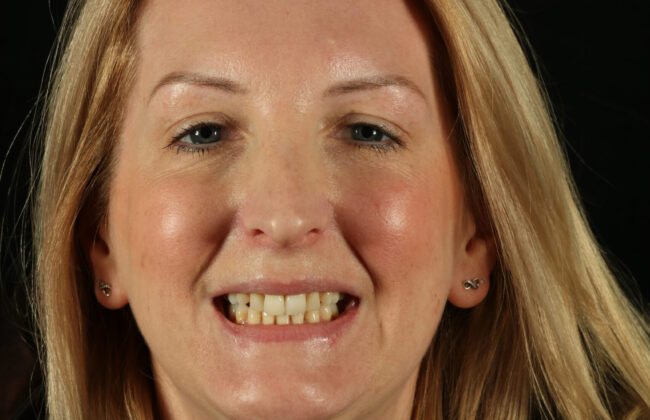 After (Teeth)