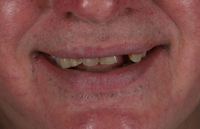 Before (Teeth)