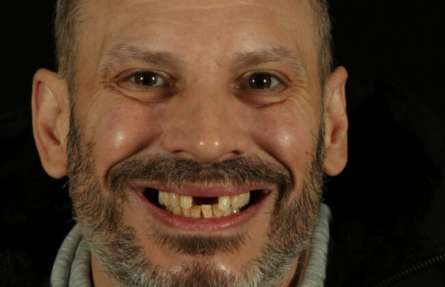Before (Teeth)