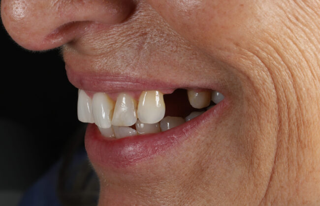 Before (Teeth)