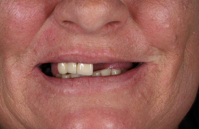 Before (Teeth)