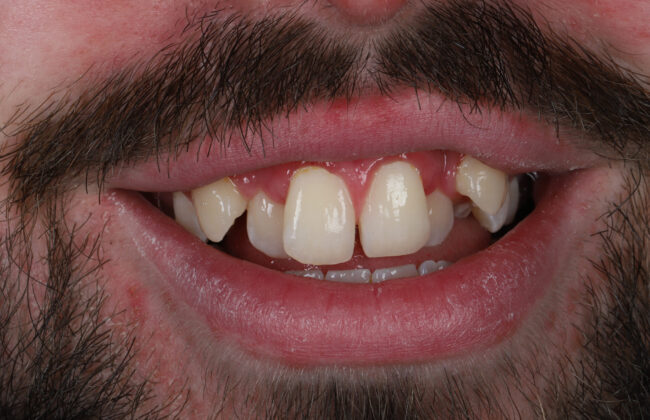 Before (Teeth)