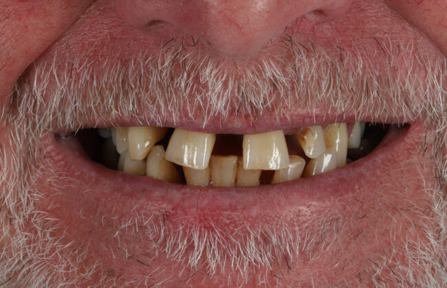 Before (Teeth)