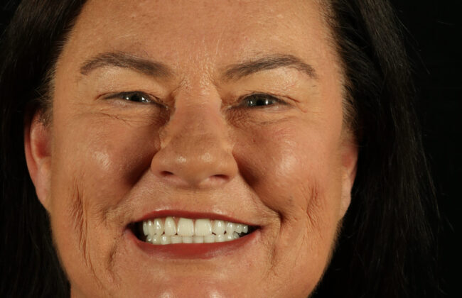 After (Teeth)