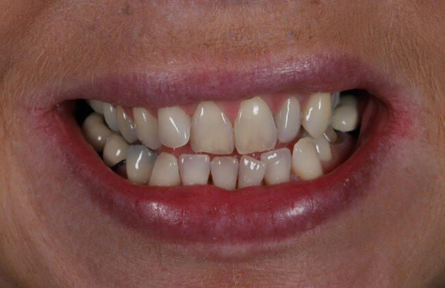 Before (Teeth)