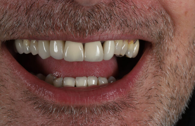 After (Teeth)