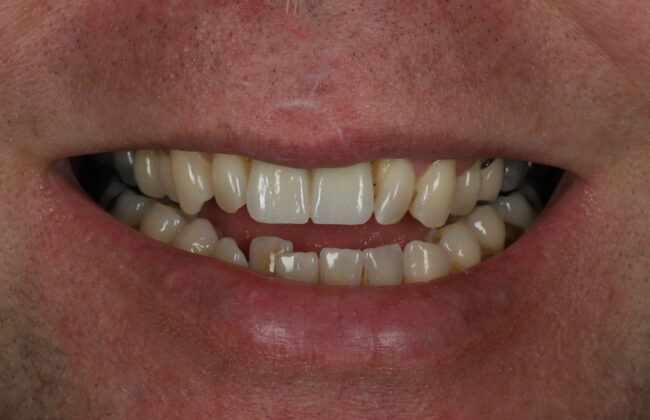 After (Teeth)