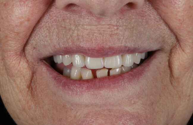 After (Teeth)