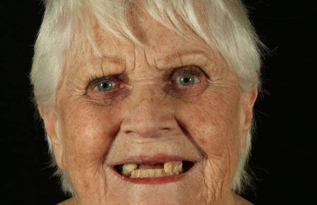 Before (Teeth)