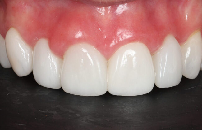 After (Teeth)