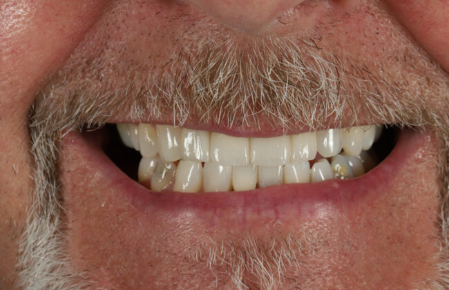 After (Teeth)