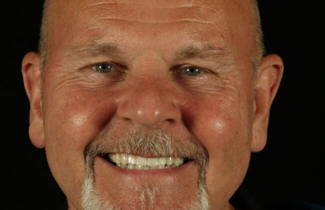After (Teeth)
