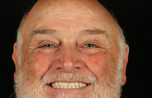 After (Teeth)