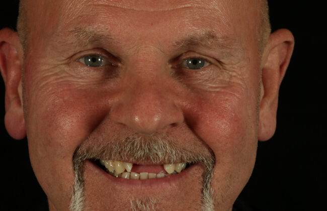 Before (Teeth)