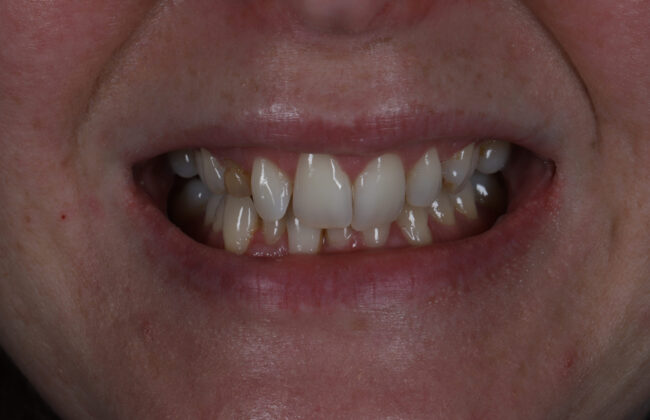 Before (Teeth)