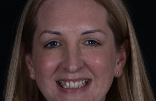 Before (Teeth)