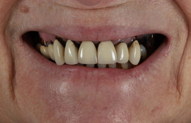Before (Teeth)
