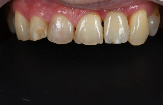 After (Teeth)