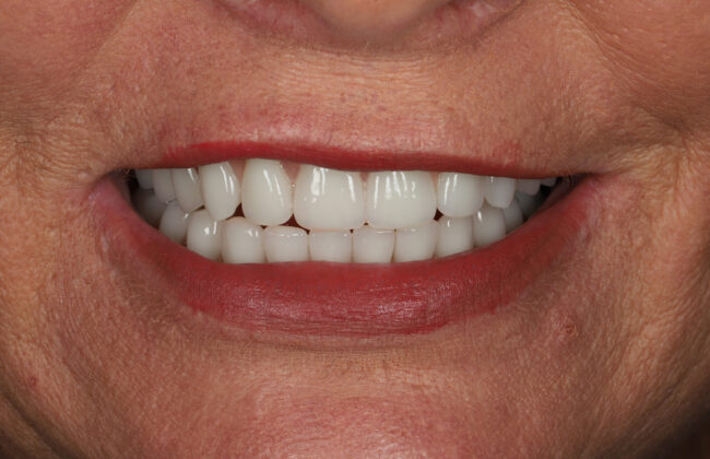 After (Teeth)