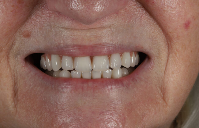 After (Teeth)