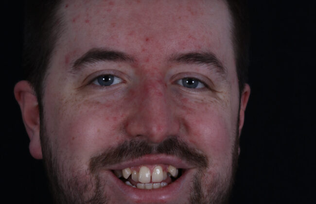 Before (Teeth)