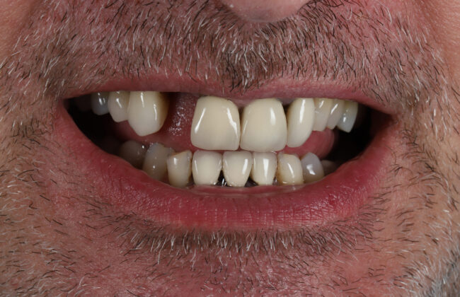 Before (Teeth)