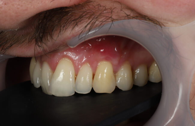 After (Teeth)