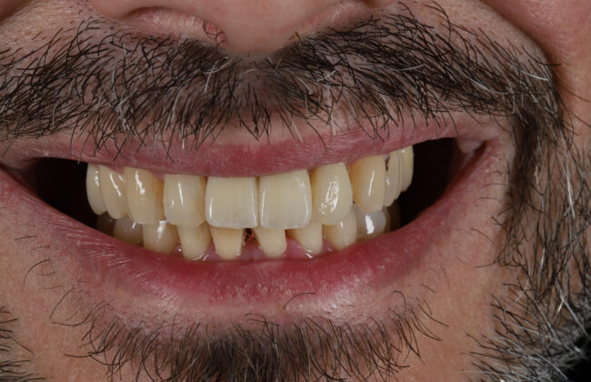 After (Teeth)
