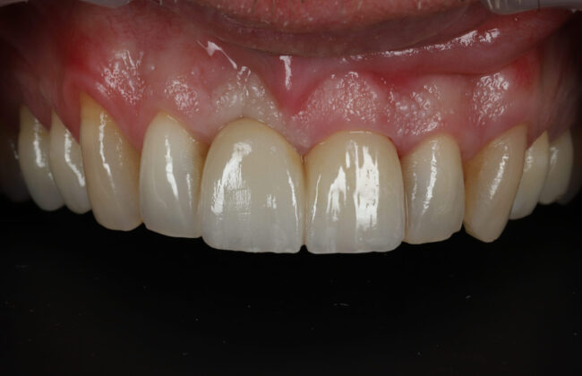 After (Teeth)
