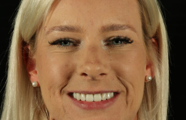 After (Teeth)