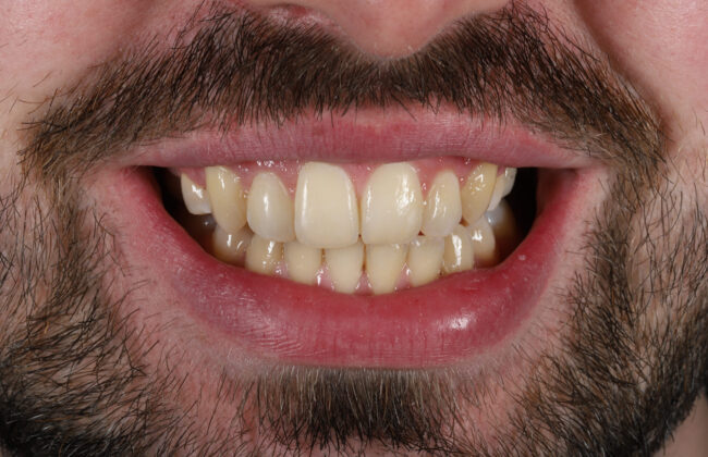 After (Teeth)
