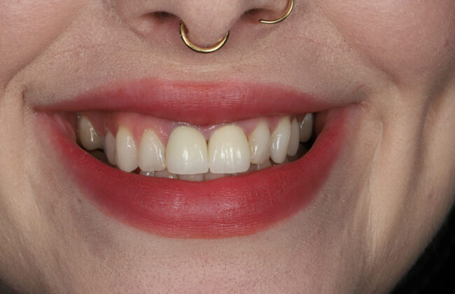 After (Teeth)