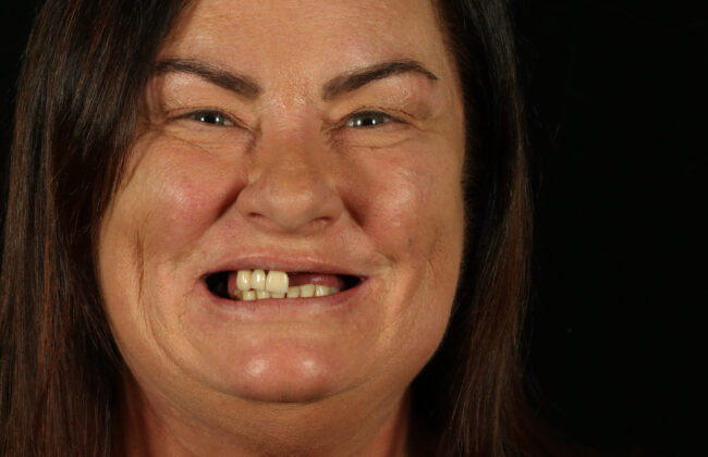 Before (Teeth)