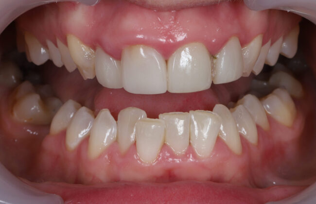 Before (Teeth)