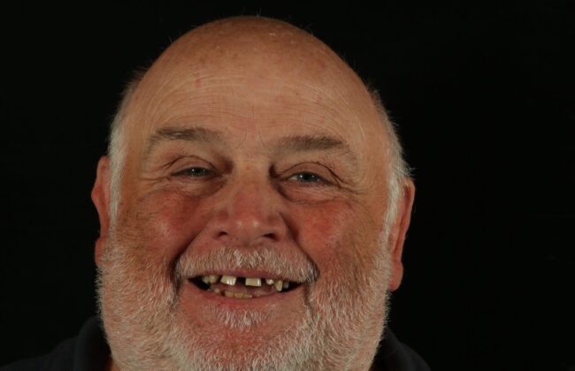 Before (Teeth)