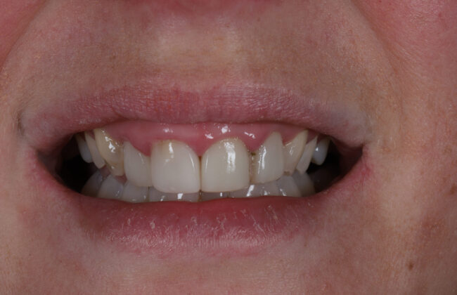 Before (Teeth)