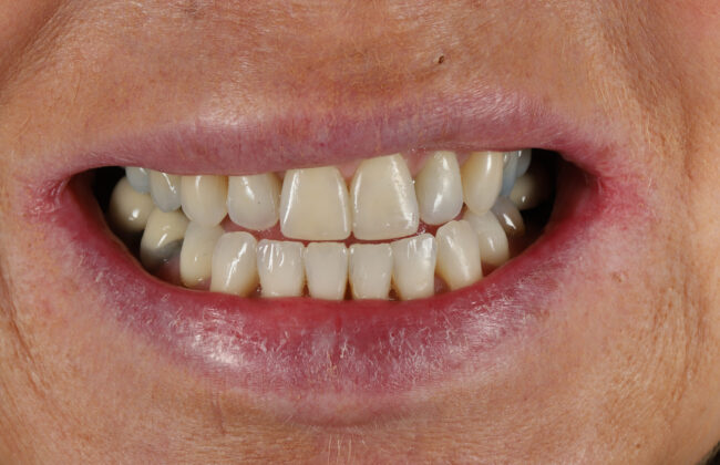 After (Teeth)