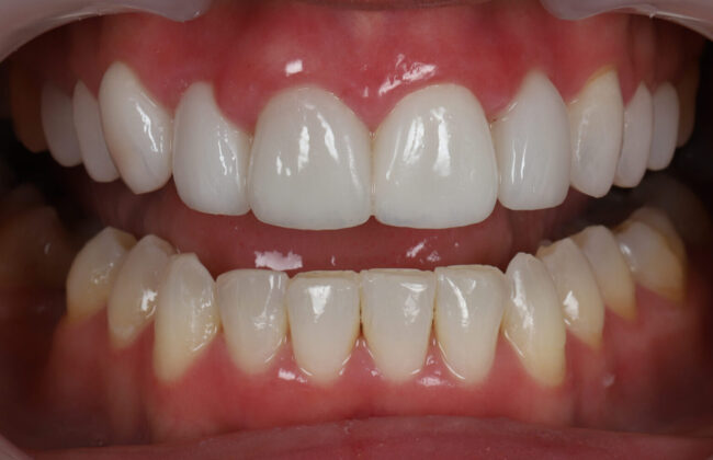 After (Teeth)