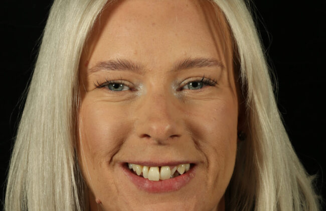 Before (Teeth)