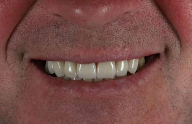 After (Teeth)