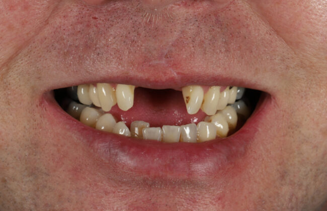 Before (Teeth)