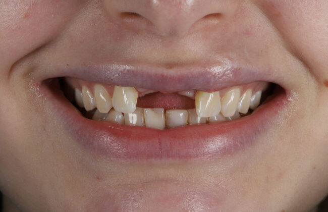 Before (Teeth)