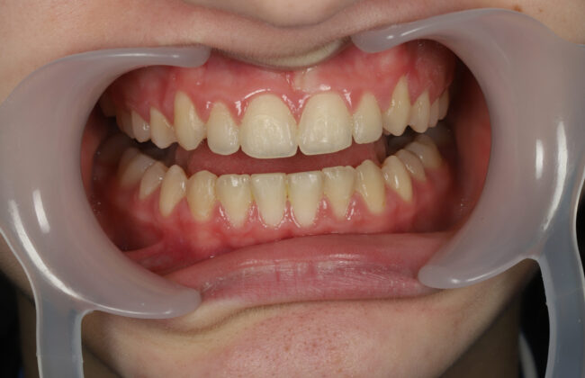 After (Teeth)