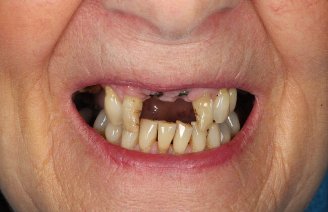 Before (Teeth)