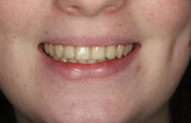 After (Teeth)
