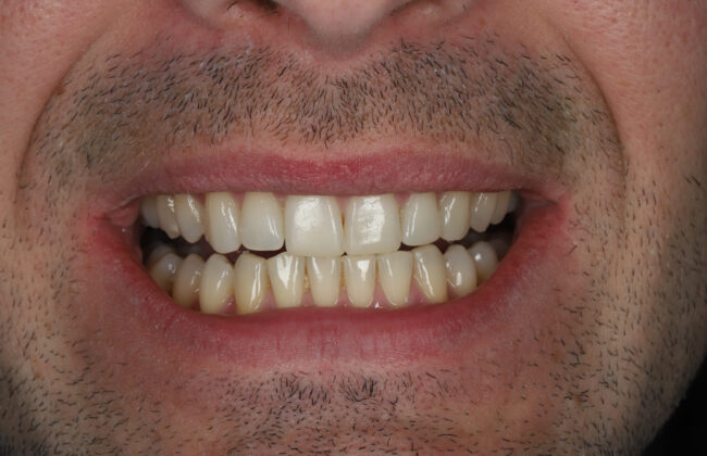 After (Teeth)