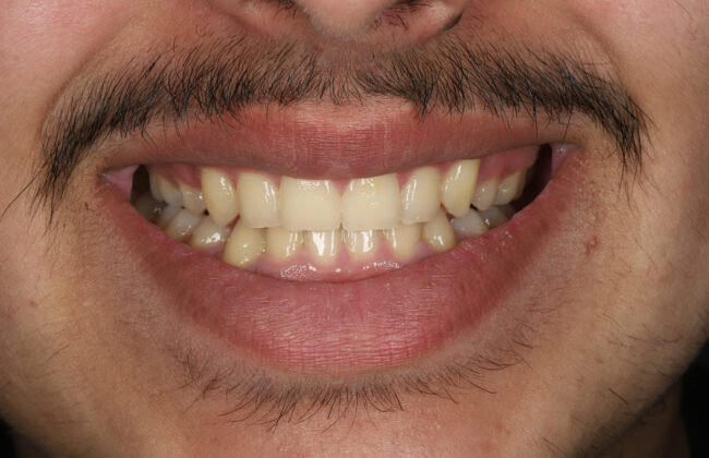 After (Teeth)