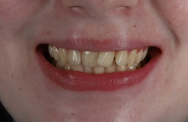 Before (Teeth)